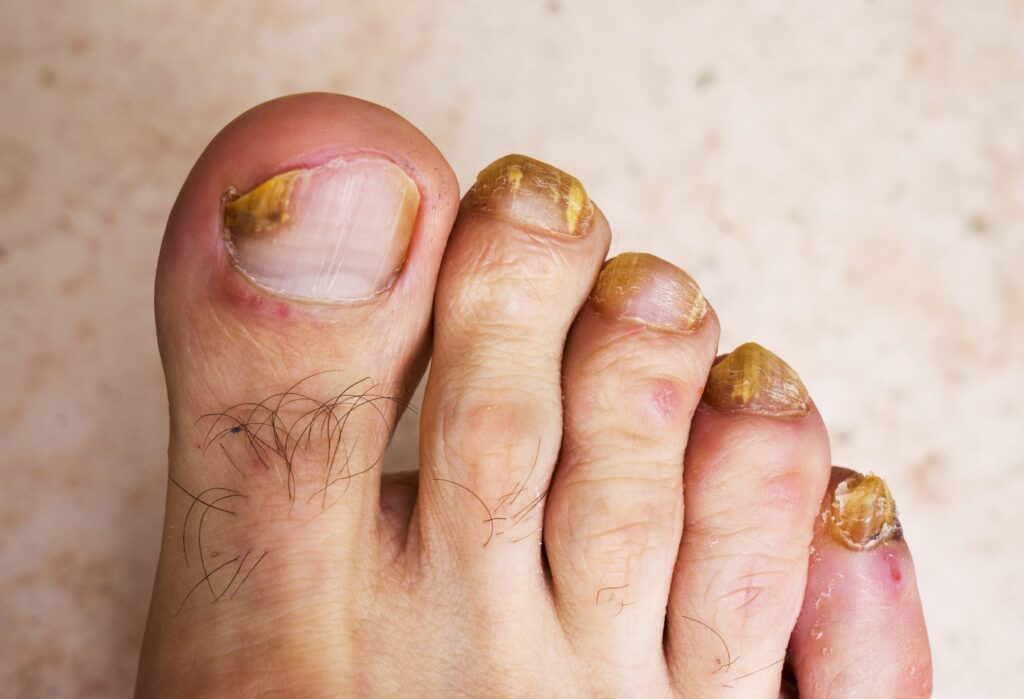 Will Bleach Get Rid of Toenail Fungus?