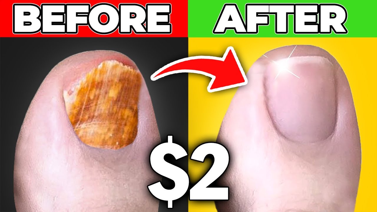 Will Bleach Get Rid of Toenail Fungus?