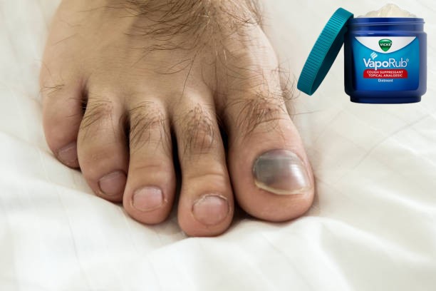 Will Bleach Get Rid of Toenail Fungus?